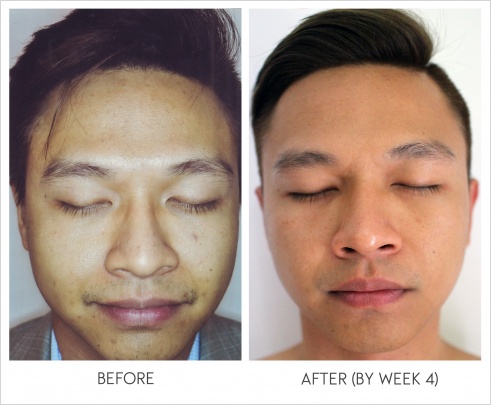 derma-rx-before-after-review